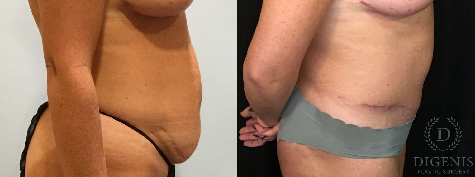 Before and after Tummy Tuck case 35094 - Angle 3