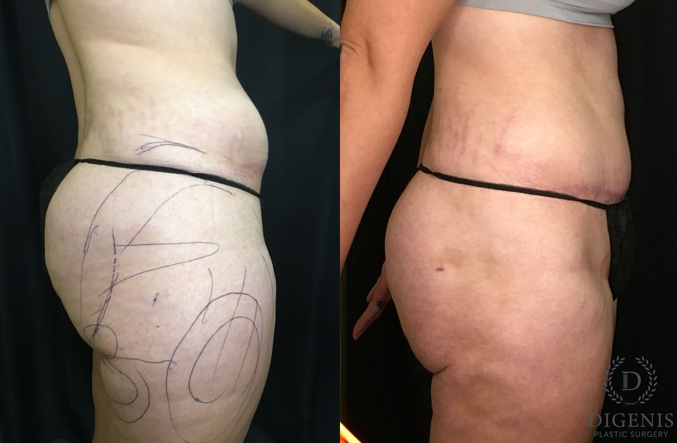 Before and after Tummy Tuck case 35180 - Angle 3
