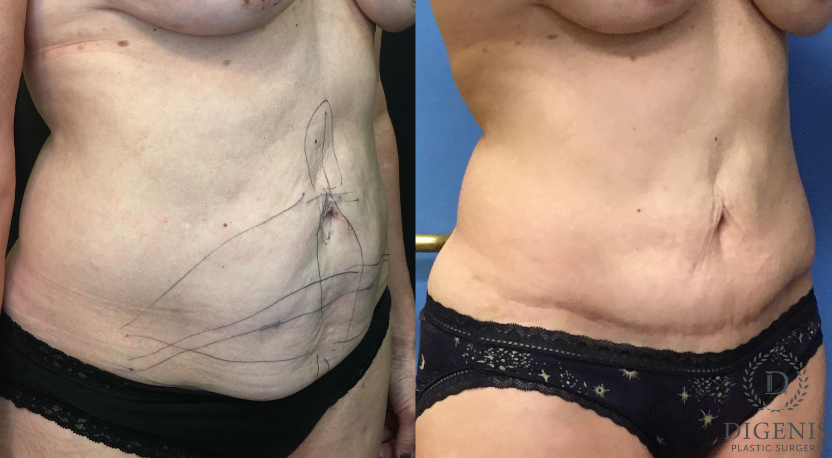 Before and after Tummy Tuck case 35184 - Angle 2