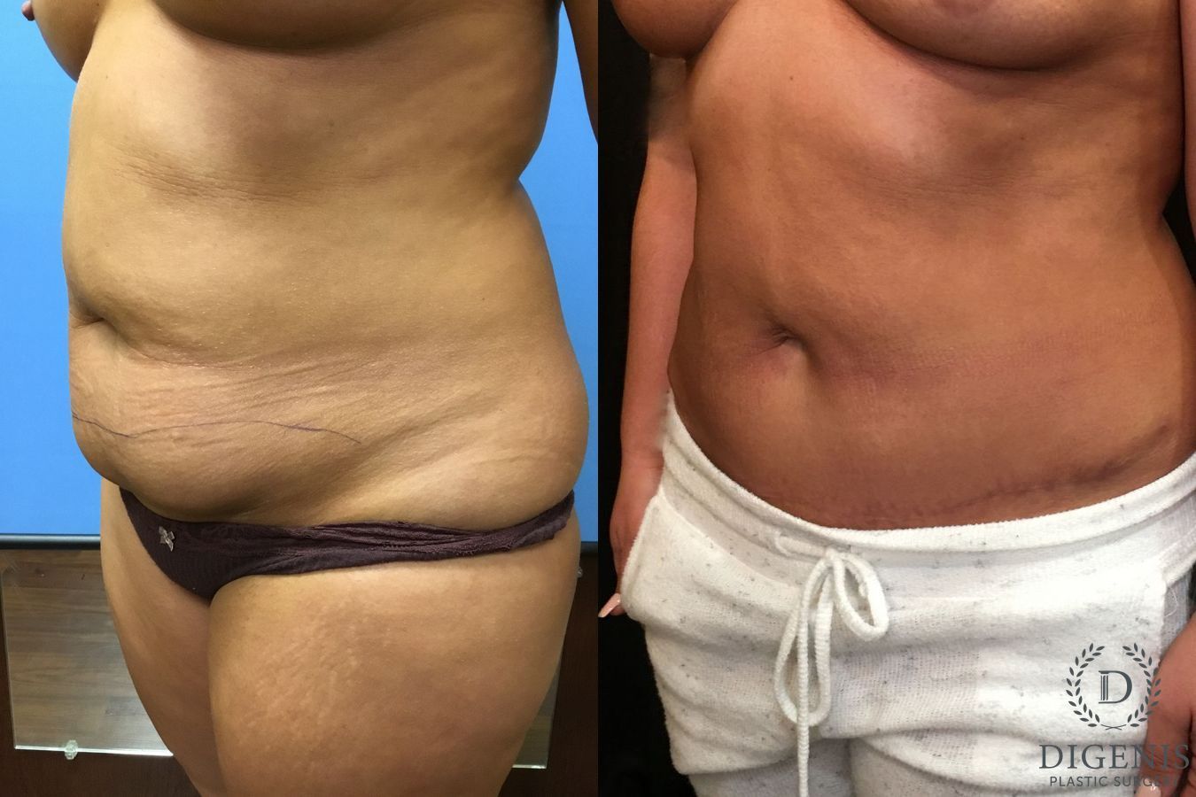 Before and after Tummy Tuck case 35066 - Angle 4
