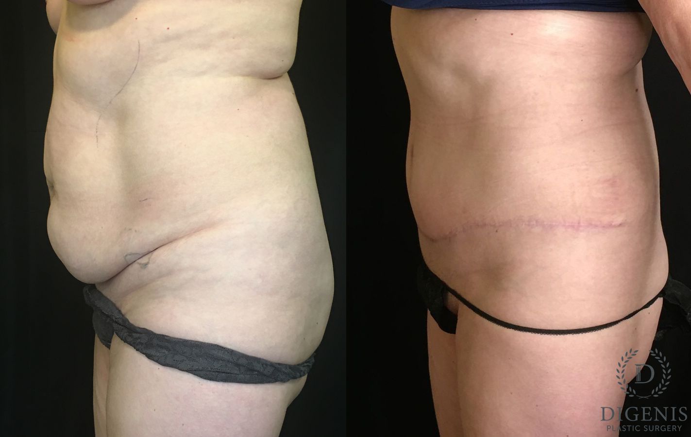 Before and after Tummy Tuck case 35191 - Angle 5