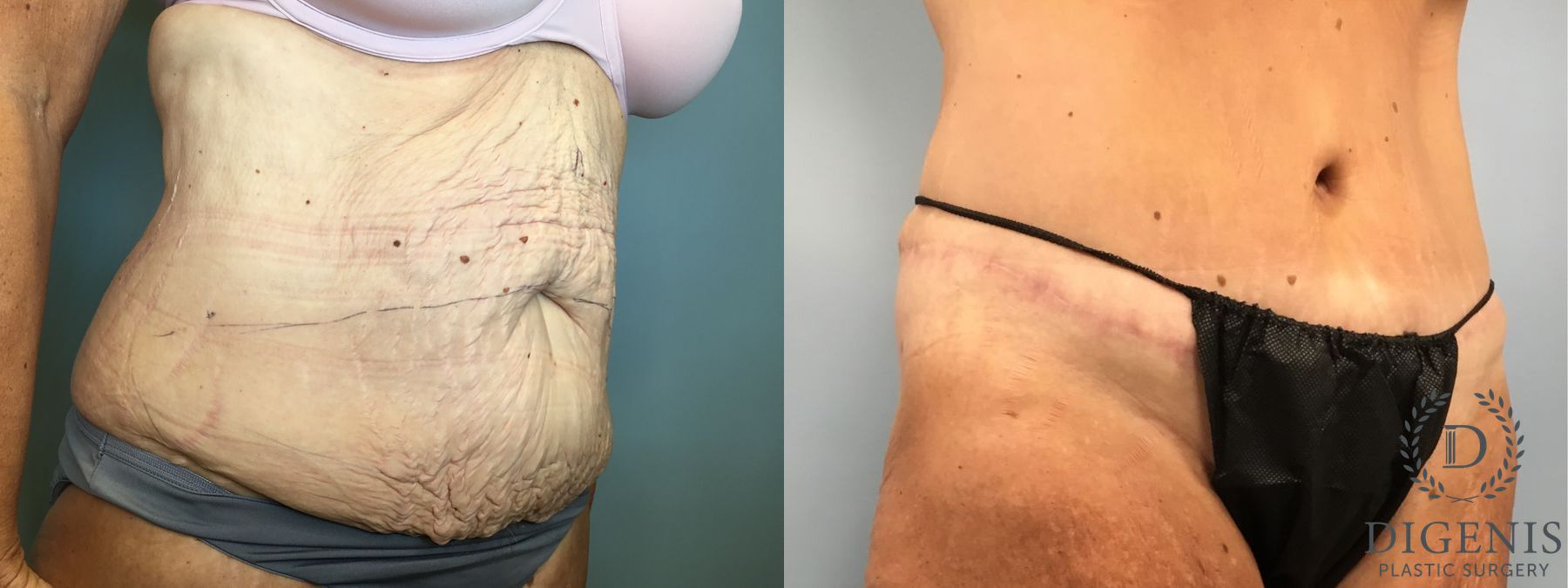 Before and after Tummy Tuck case 43252 - Angle 2