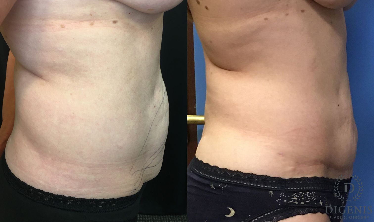 Before and after Tummy Tuck case 35184 - Angle 3