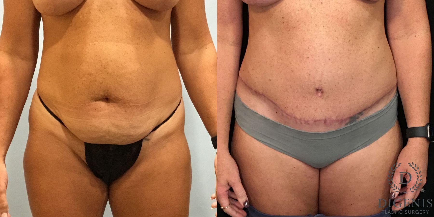 Before and after Tummy Tuck case 35094