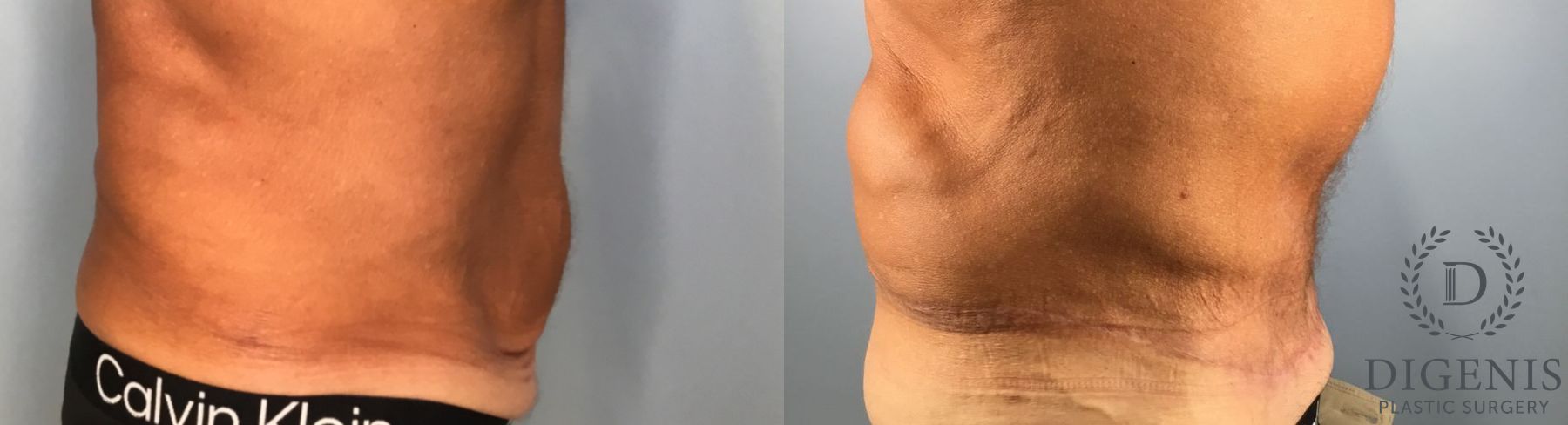 Before and after Tummy Tuck case 43448 - Angle 5
