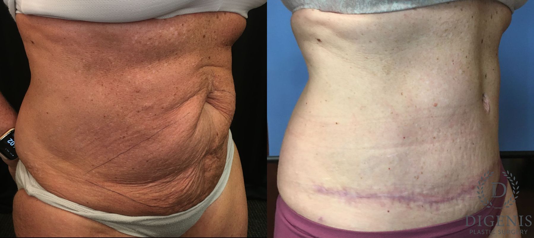 Before and after Tummy Tuck case 35149 - Angle 2