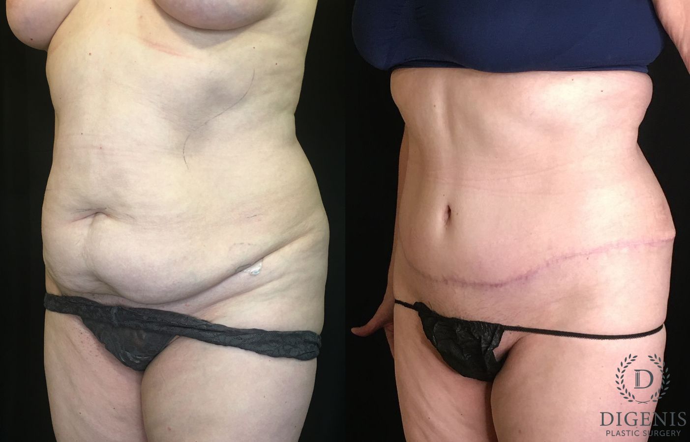 Before and after Tummy Tuck case 35191 - Angle 4