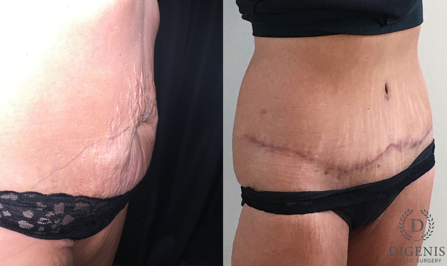 Before and after Tummy Tuck case 35185 - Angle 2