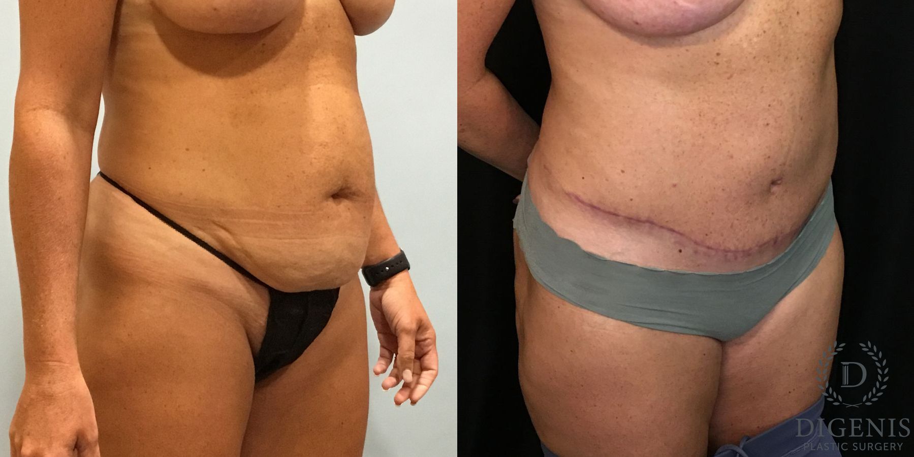 Before and after Tummy Tuck case 35094 - Angle 2