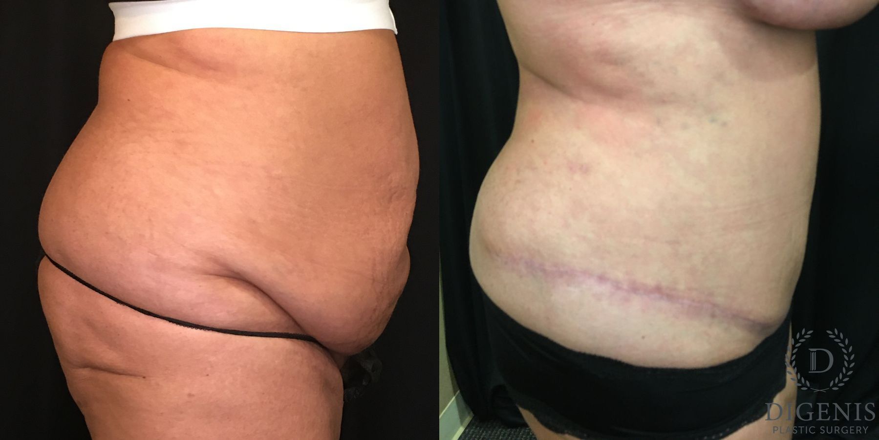 Before and after Tummy Tuck case 35143 - Angle 3