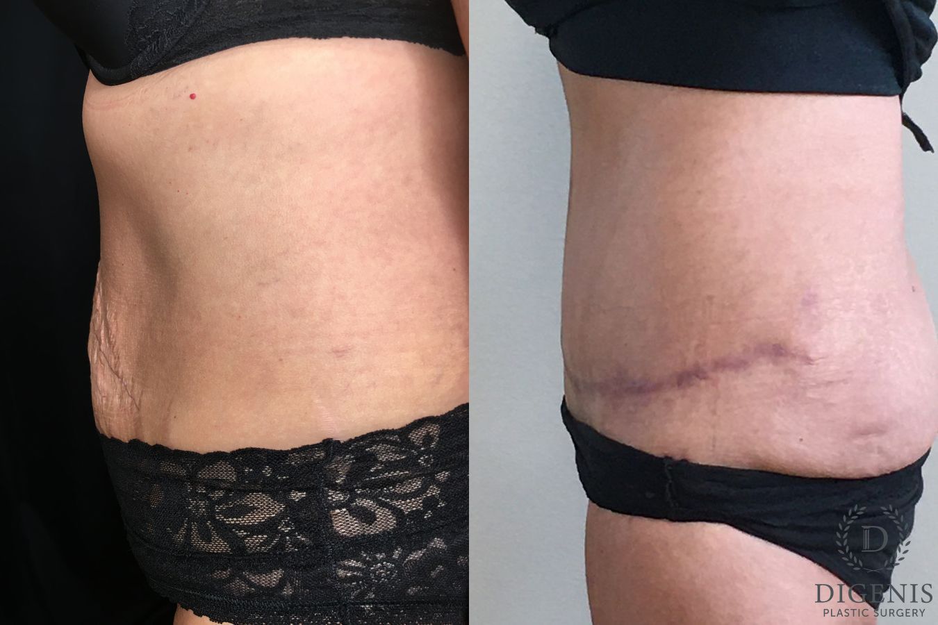 Before and after Tummy Tuck case 35185 - Angle 5