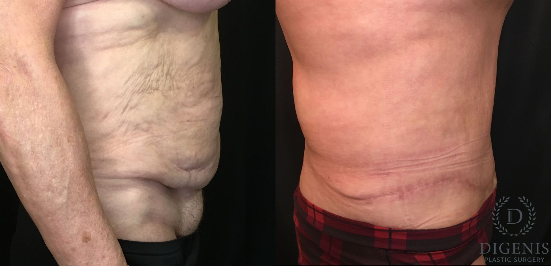 Before and after Tummy Tuck case 35148 - Angle 3