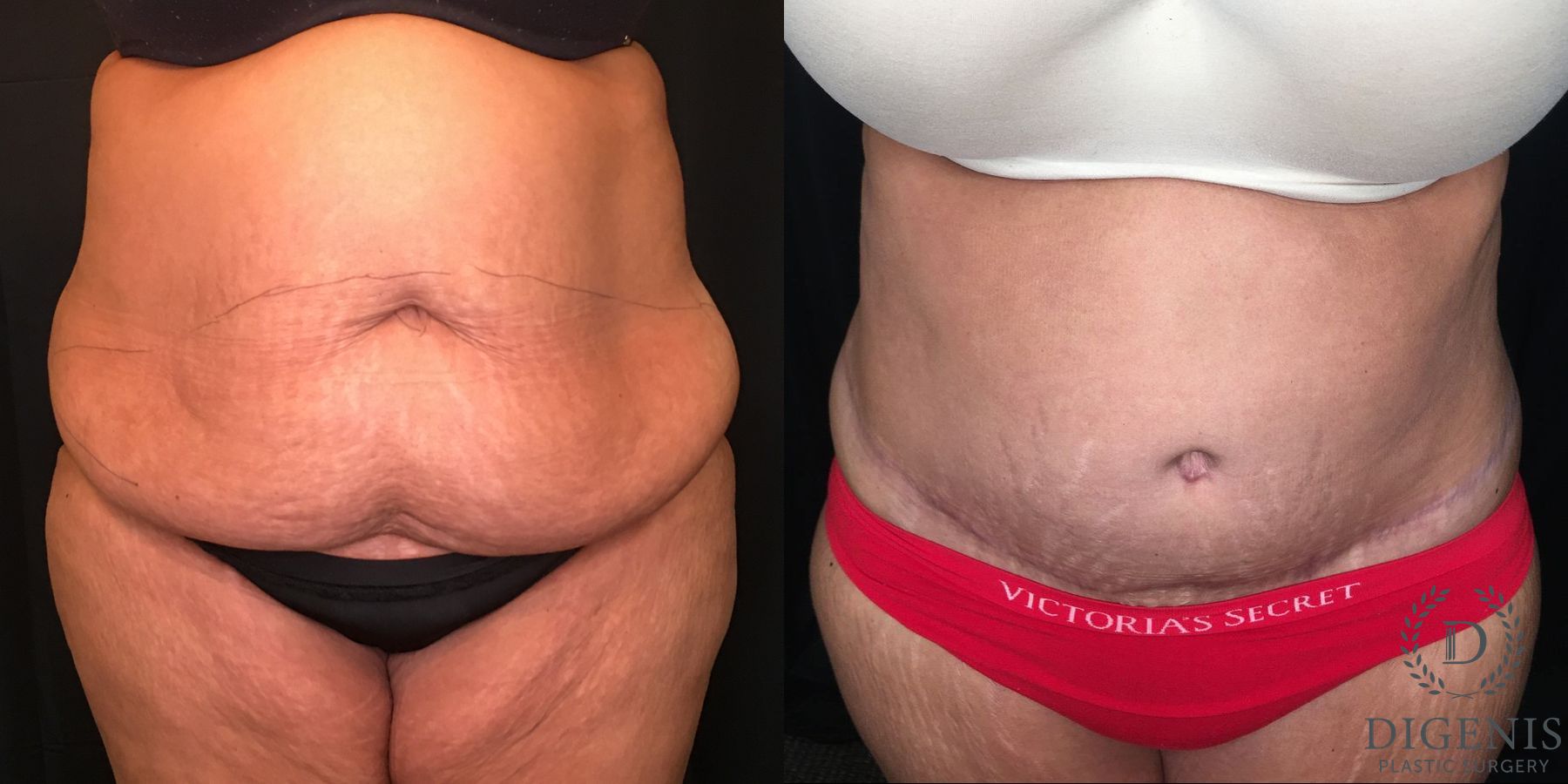 Before and after Tummy Tuck case 35173