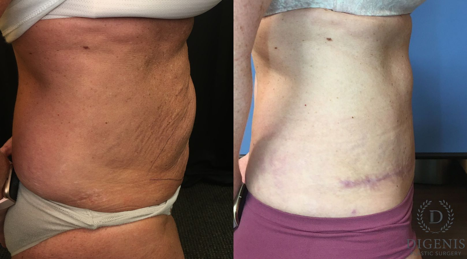 Before and after Tummy Tuck case 35149 - Angle 3