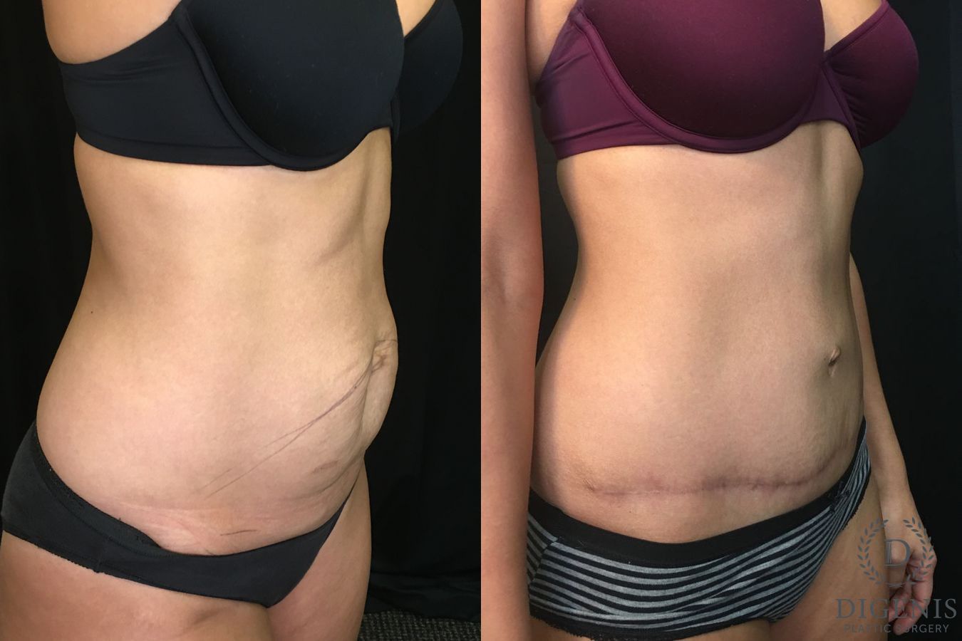Before and after Tummy Tuck case 35152 - Angle 2