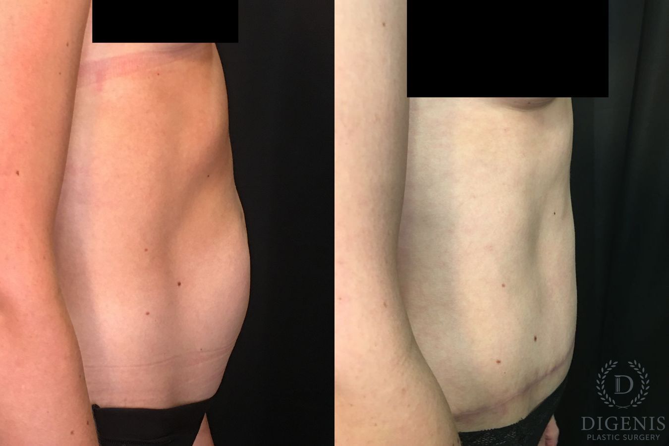 Before and after Tummy Tuck case 35052 - Angle 3