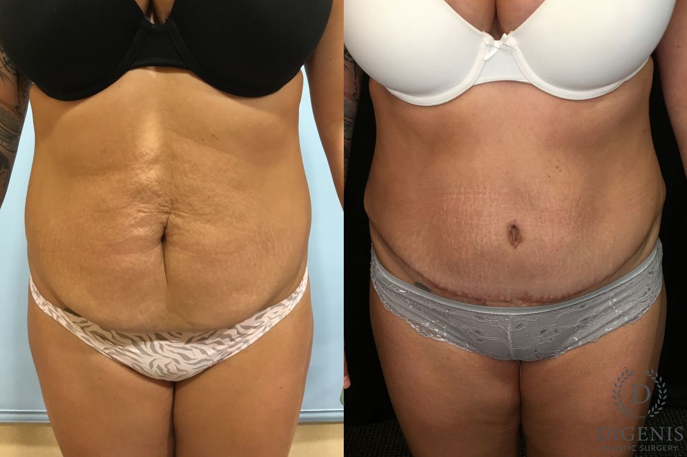 Before and after Tummy Tuck case 35128