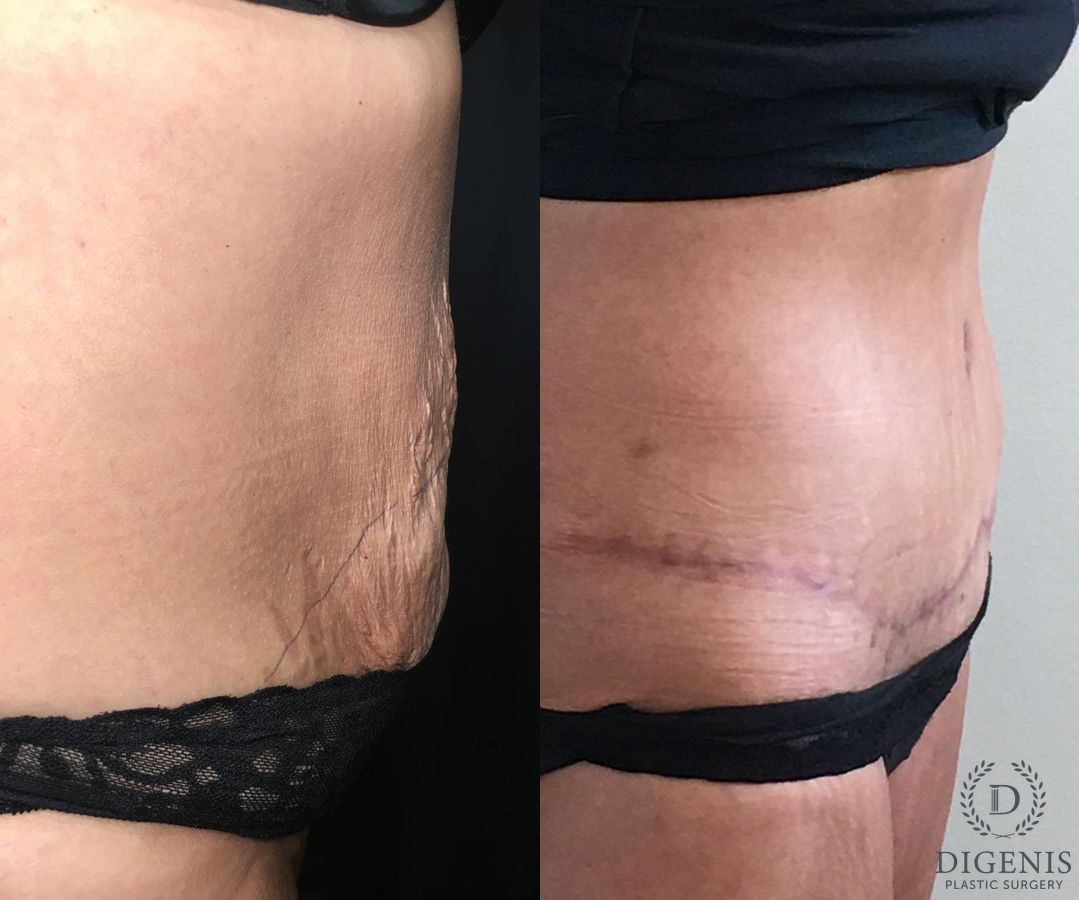Before and after Tummy Tuck case 35185 - Angle 3