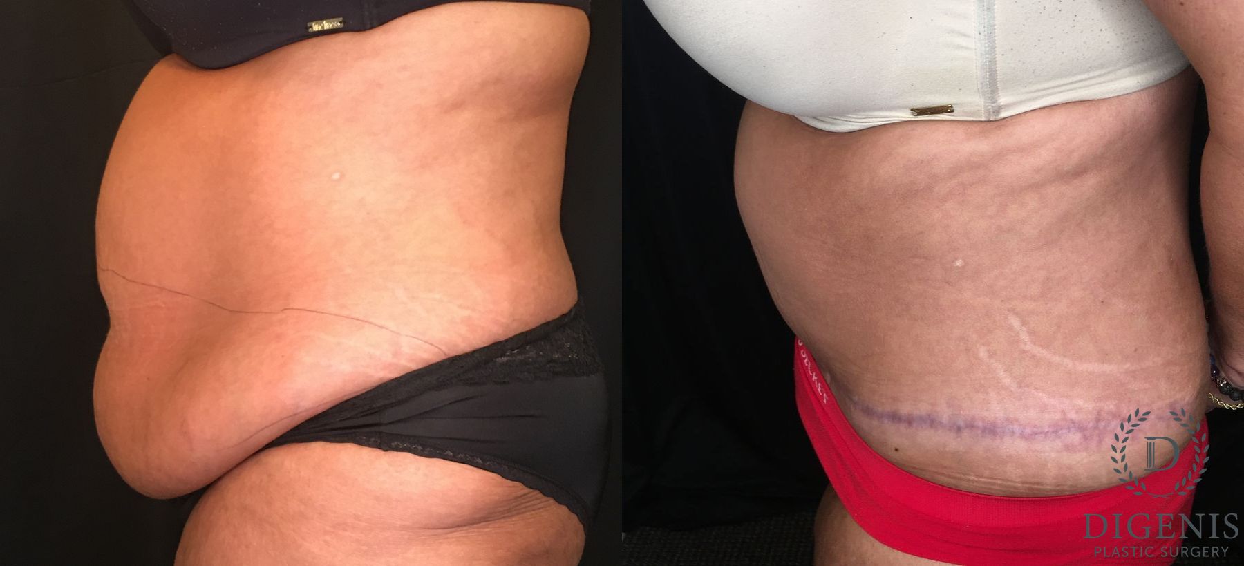 Before and after Tummy Tuck case 35173 - Angle 5