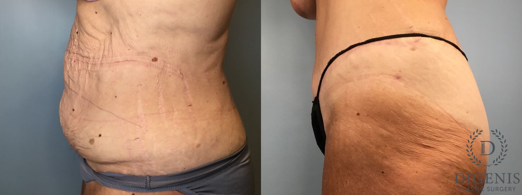 Before and after Tummy Tuck case 43252 - Angle 5