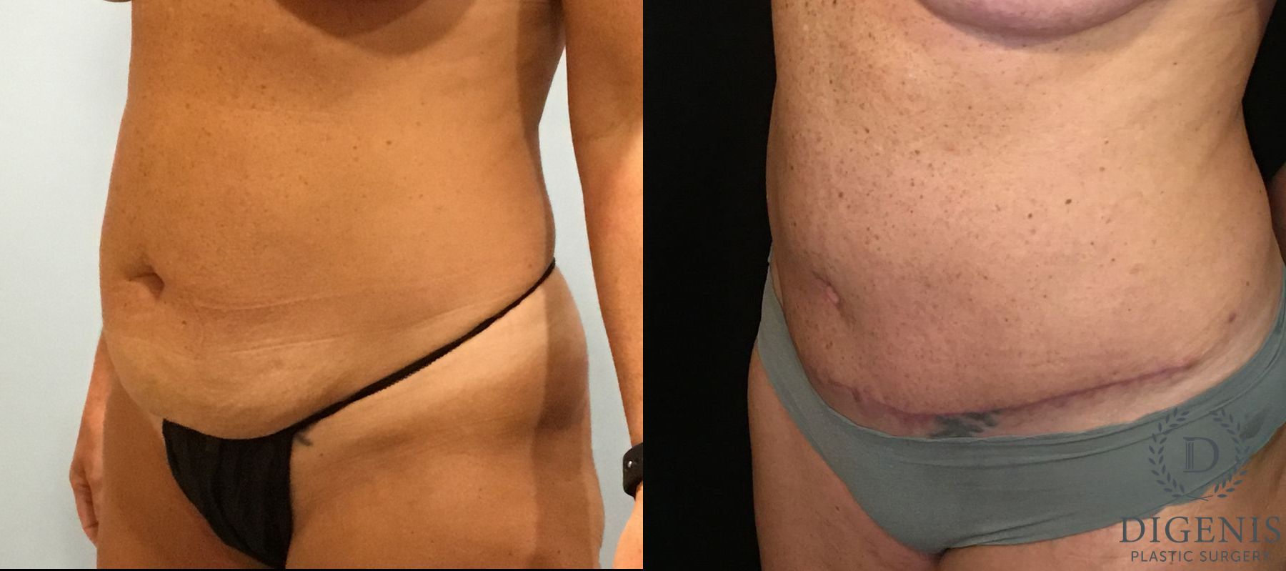 Before and after Tummy Tuck case 35094 - Angle 4