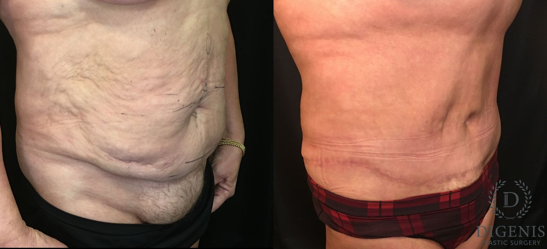 Before and after Tummy Tuck case 35148 - Angle 2