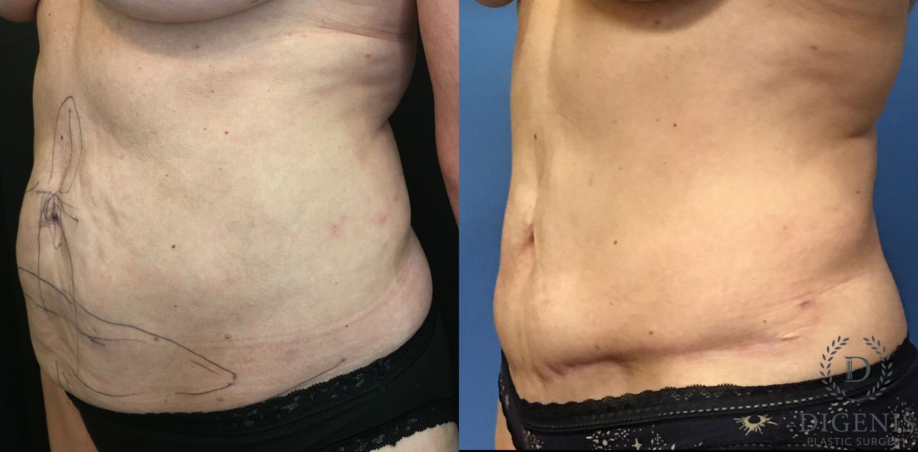 Before and after Tummy Tuck case 35184 - Angle 4
