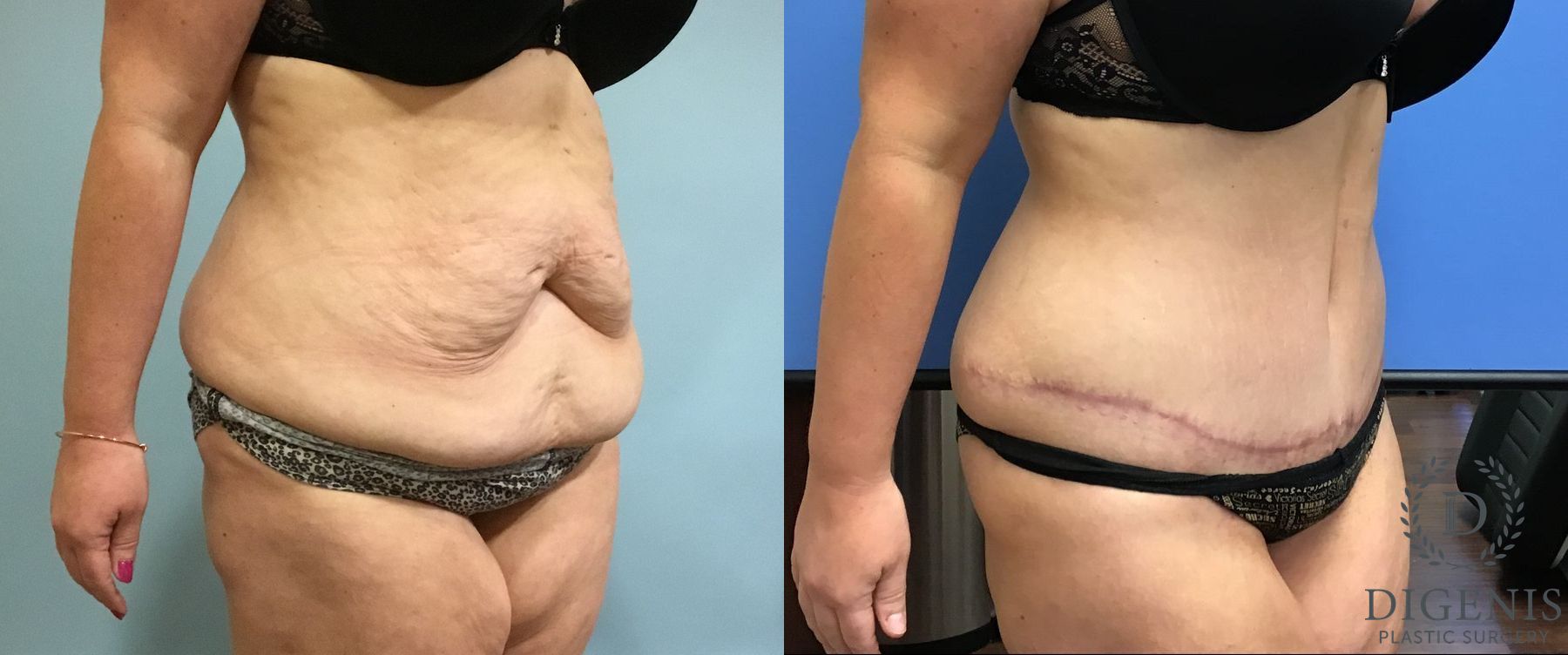 Before and after Tummy Tuck case 35090 - Angle 2