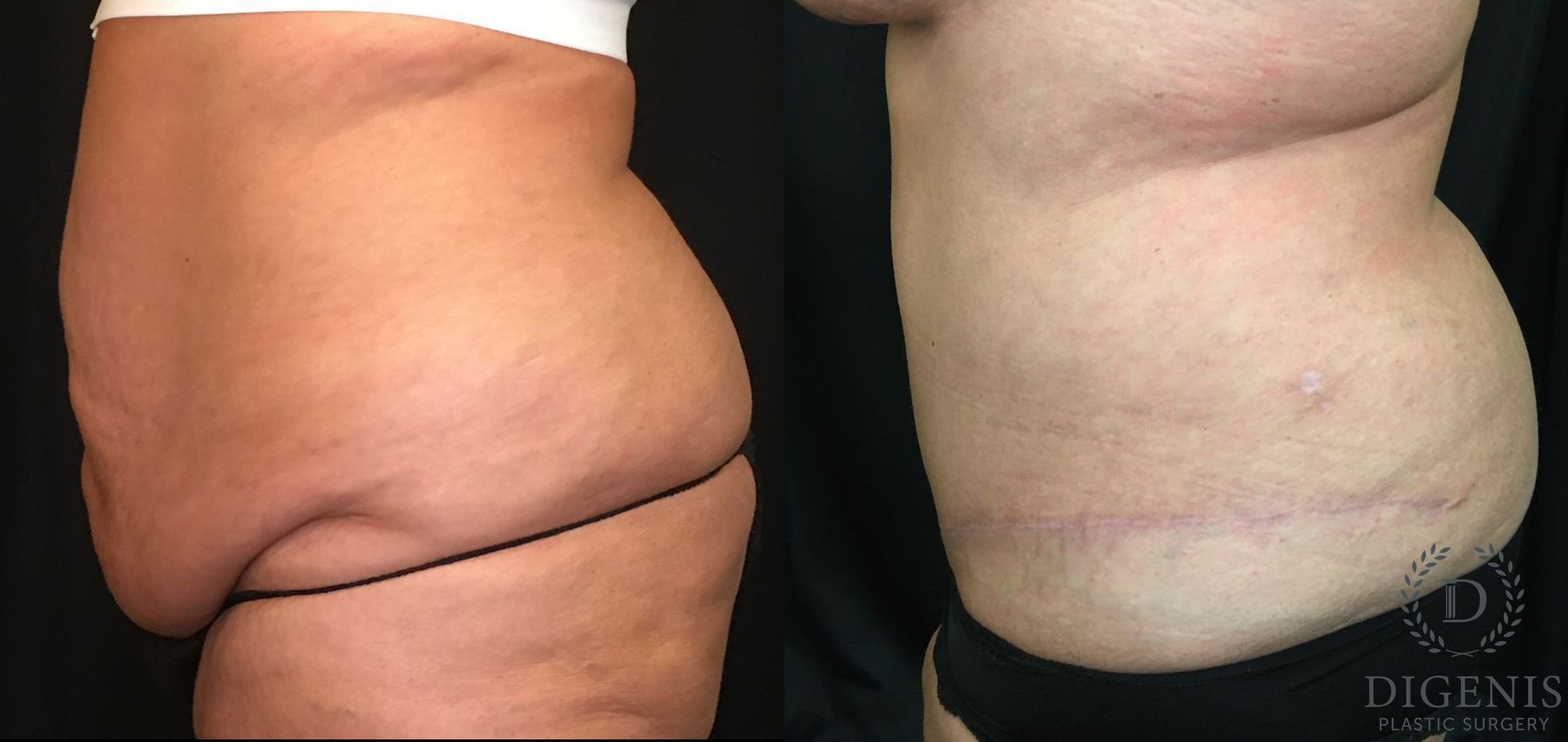 Before and after Tummy Tuck case 35143 - Angle 4