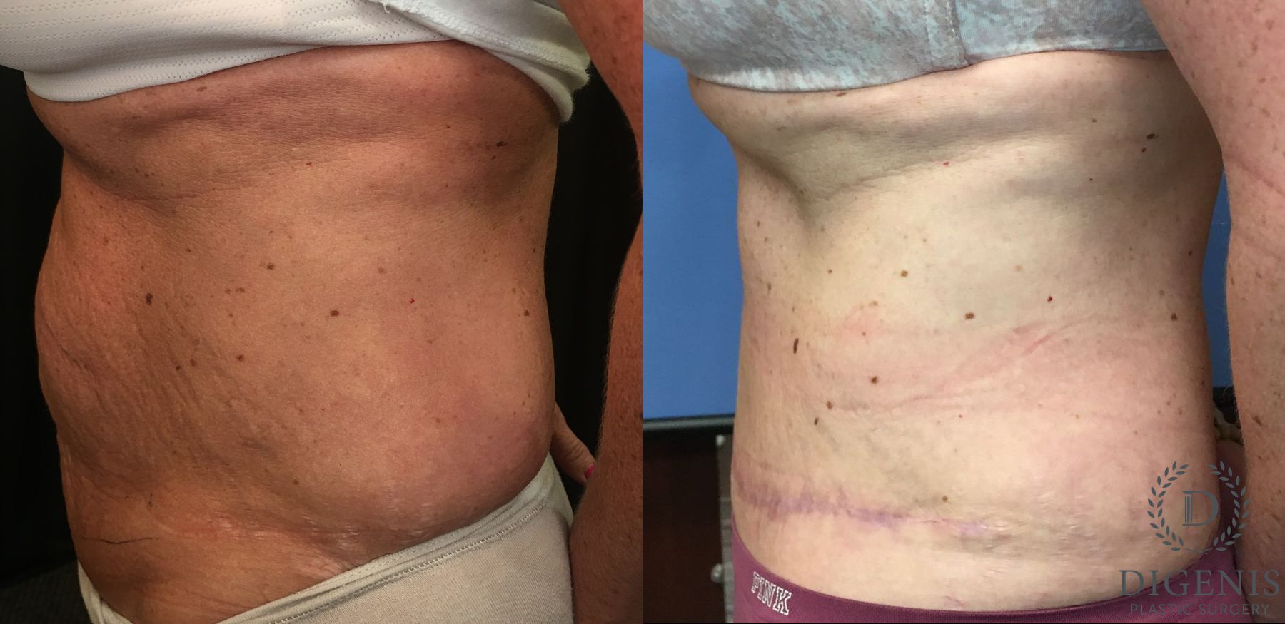 Before and after Tummy Tuck case 35149 - Angle 5