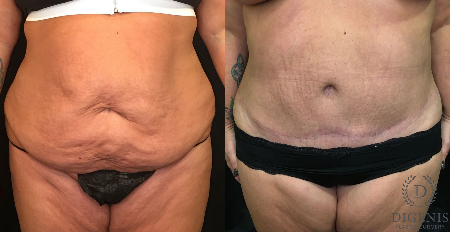 Before and after Tummy Tuck case 35143