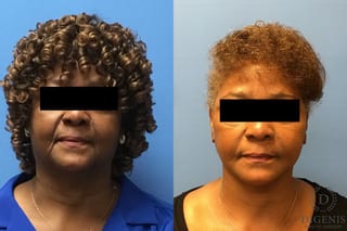 Before and after Face Lift/Neck Lift case 34959 - Angle 1
