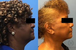 Before and after Face Lift/Neck Lift case 34959 - Angle 3