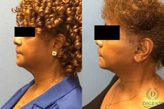 Before and after Face Lift/Neck Lift case 34959 - Angle 4
