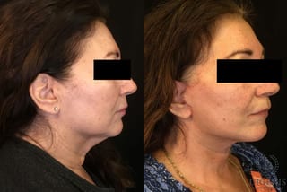 Before and after Face Lift/Neck Lift case 34960 - Angle 2