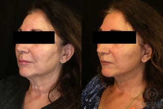Before and after Face Lift/Neck Lift case 34960 - Angle 3