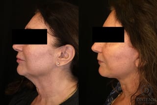 Before and after Face Lift/Neck Lift case 34960 - Angle 4