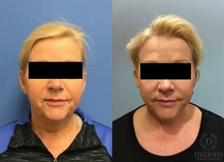 Before and after Face Lift/Neck Lift case 34961 - Angle 1