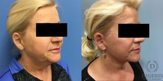 Before and after Face Lift/Neck Lift case 34961 - Angle 2