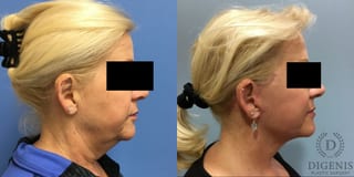 Before and after Face Lift/Neck Lift case 34961 - Angle 3