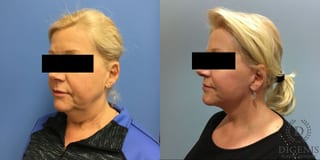 Before and after Face Lift/Neck Lift case 34961 - Angle 4