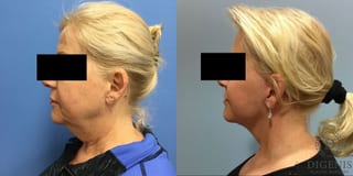 Before and after Face Lift/Neck Lift case 34961 - Angle 5