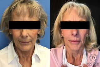 Before and after Face Lift/Neck Lift case 34962 - Angle 1