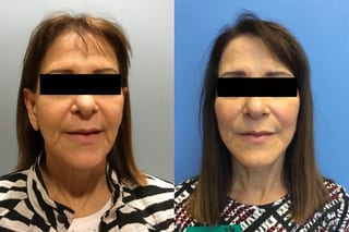 Before and after Face Lift/Neck Lift case 34963 - Angle 1