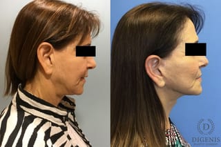 Before and after Face Lift/Neck Lift case 34963 - Angle 3