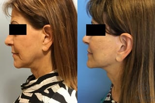 Before and after Face Lift/Neck Lift case 34963 - Angle 5