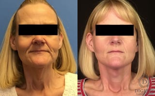 Before and after Face Lift/Neck Lift case 34964 - Angle 1