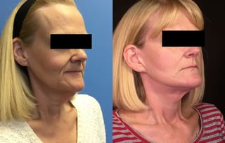 Before and after Face Lift/Neck Lift case 34964 - Angle 2