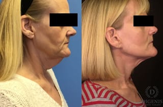 Before and after Face Lift/Neck Lift case 34964 - Angle 3