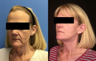Before and after Face Lift/Neck Lift case 34964 - Angle 4